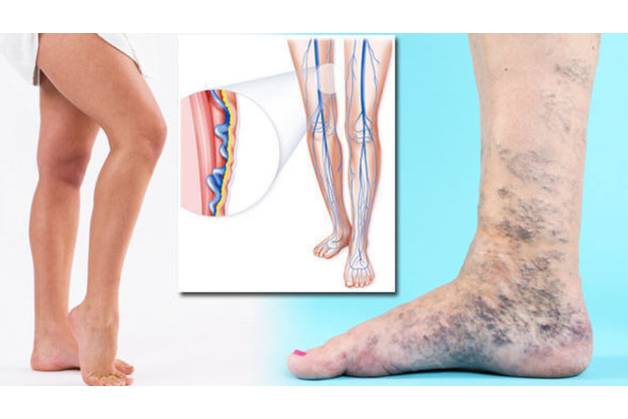 Obrázok ku článku Kŕčové žily: Kedy sa obávať a prečo?
