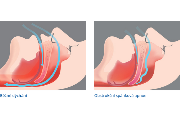 Obrázok ku článku Čo je spánkové apnoe alebo veľký pozor na chrápanie.